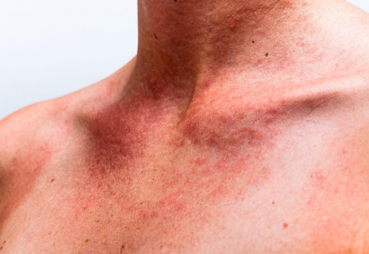 Пигментные пятна — причины появления, как избавиться от пятен на лице и на теле