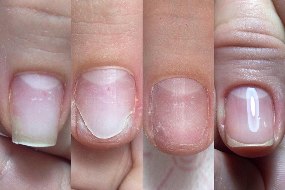 Профилактика и лечение онихорексиса (расщепления ногтей)